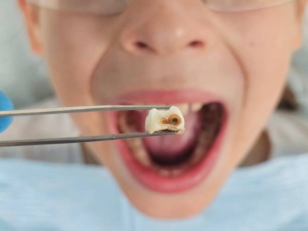 Best Knocked-Out Tooth (Avulsed Tooth) Treatment in Redwater, TX
